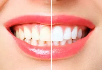 Teeth Whitening Stafford